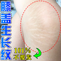 Obesity lines repair cream growth lines elimination long horizontal lines on thighs students knees white lines repair and lightening cream