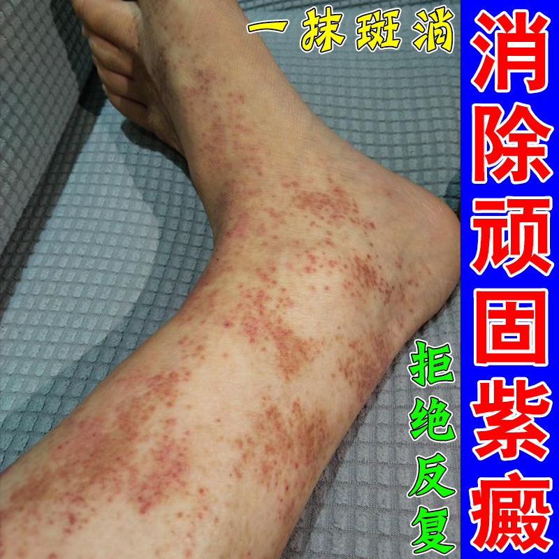 紫斑病特効薬 皮下出血 赤い斑点 老人性皮膚炎 血管炎 小児単純性紫斑病軟膏