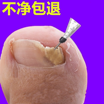 Tong Ren Tang sells 100000 yuan no guarantee no repair (one drop) painlessly removes bad potassium from hands and toes gray potassium nemesis