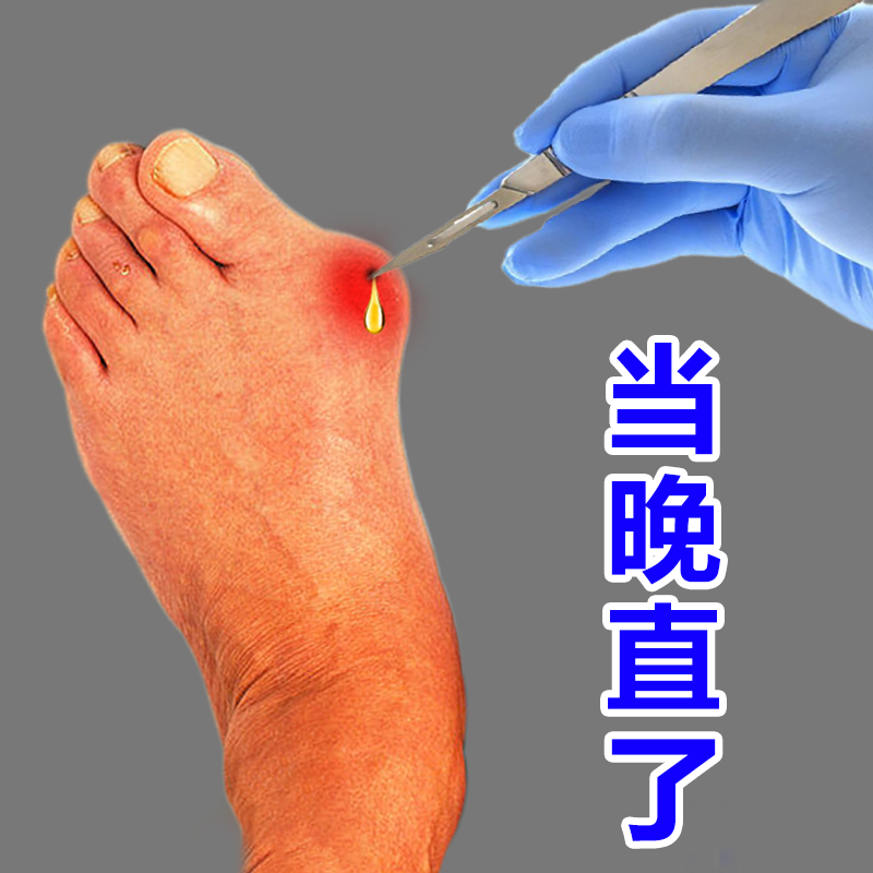 (Not Straight Full Odds) thumb valgus paste Paste Correction Large Footed Bone Toe Overlap Special Cream Stick Valgus Valgus Deity-Taobao