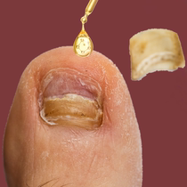 The effect is great (refundable if not used) 99% repurchase rate. Just one drop will turn bad nail into good potassium and enjoy a good nail life.