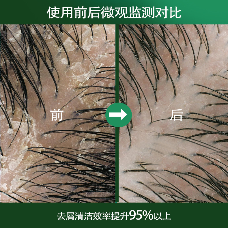 强力去屑止痒洗发水哪家强，真的难选吗？