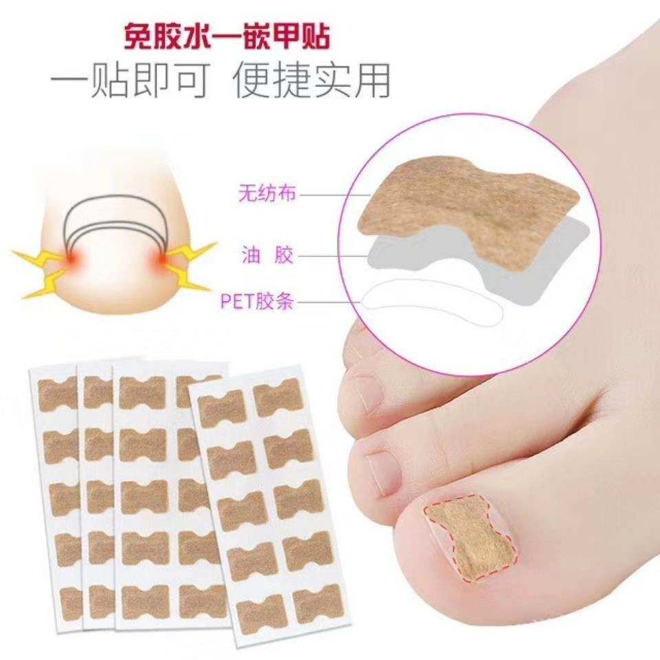 免胶水正甲贴片一贴矫正嵌甲甲沟矫正神器专用修正大脚指甲长肉里