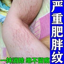 去肥胖纹修复霜生长纹消除大腿学生青少年肚子屁股淡化纹路修复膏
