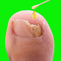 Buy two get one free (Tongrentang hot sale 100000) No guarantee or repair. Painlessly remove broken fingers and toes with just one drop.