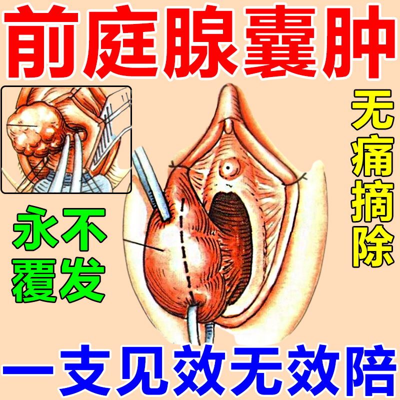 Vestibular glandular glandular cysts external to the outside with burning sensation of burning sensation Swelling Pain Cyst Drum Bag Dredge Gynecological Gel-Taobao