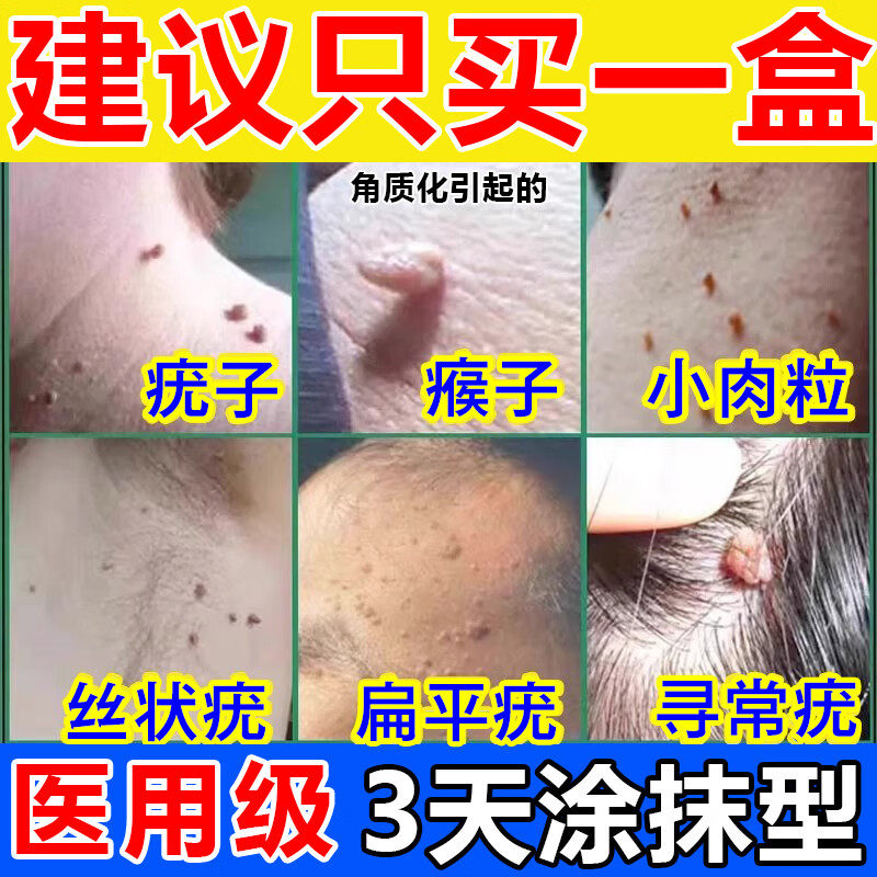 维A酸乳膏去疣神器！扁平疣/丝状疣/小肉粒全搞定！-皮脂汗腺-淘宝好物网