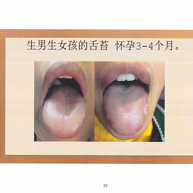 Yang Chunhu’s Tongue Diagnosis Formulas and Basic Knowledge of Tongue Diagnosis and Disease Recognition: Start with Dialectics of Tongue Quality for Typhoid Fever, Color Print