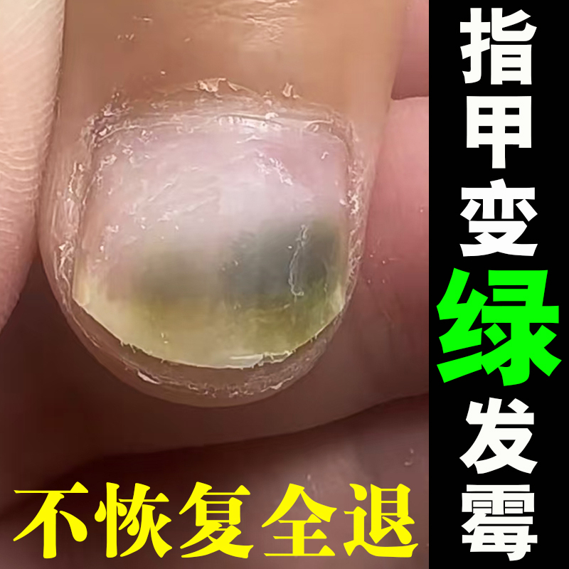 Nail Green Fungus Infection Repair Solution Treats Separation of Nail and Flesh, Damage, Unevenness, Vertical Lines, Pits, and Cracks Nail Green Fungus Infection Repair Solution Treats Separation of Nail and Flesh, Damage, Unevenness, Vertical Lines, Pits, and Cracks