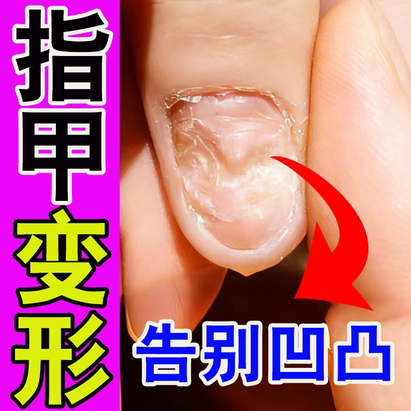 Nail Repair Growth Solution for Deformed Nails, Uneven Nails, Nail Biting, Spoon-Shaped Nails, Nail Depressions, and Pits Nail Repair Growth Solution for Deformed Nails, Uneven Nails, Nail Biting, Spoon-Shaped Nails, Nail Depressions, and Pits