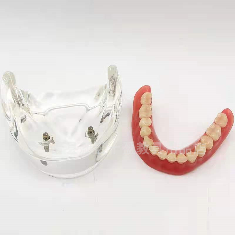 牙科口腔模型半口牙齿修复模型 种植与修复2颗钉假牙示范配戴模型