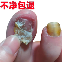 (Watsons best-selling) One drop of it can inhibit bacteria without removing nails and remove 99% of gray potassium fungi. If invalid return guarantee