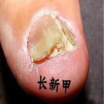 (Tongrentang hot sale) Painless replacement of potassium enjoy a good nail life turn bad nails into good ones drop by drop