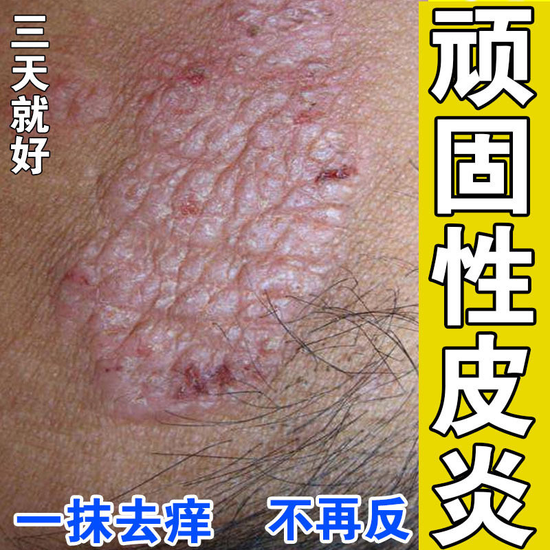 告别瘙痒烦恼！治疗神经性皮炎、顽固湿疹、干皮癣藓真菌感染专用膏，你值得拥有！-户外应急装备-淘宝好物网