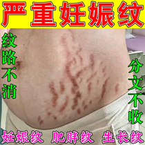 Special anti-wrinkle cream for pregnant women stretch mark repair cream eliminates fat lines on inner thighs calves waist and abdomen tightens belly