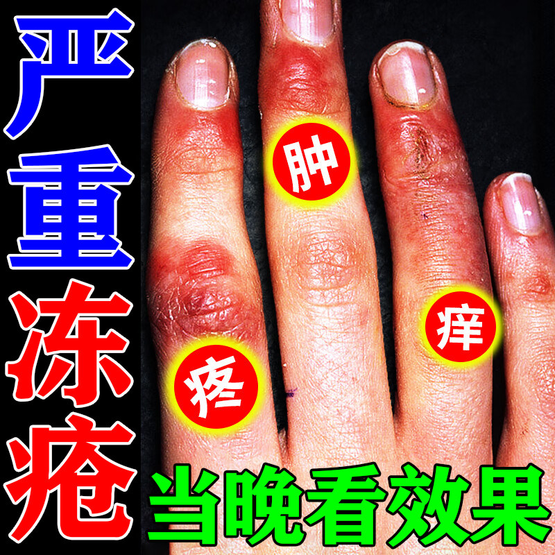 冻疮膏止痒冻伤膏药消肿防成人儿童手脚耳朵脸部冻裂专用冻疮神器,真的靠谱吗?_护手霜_淘宝美妆网