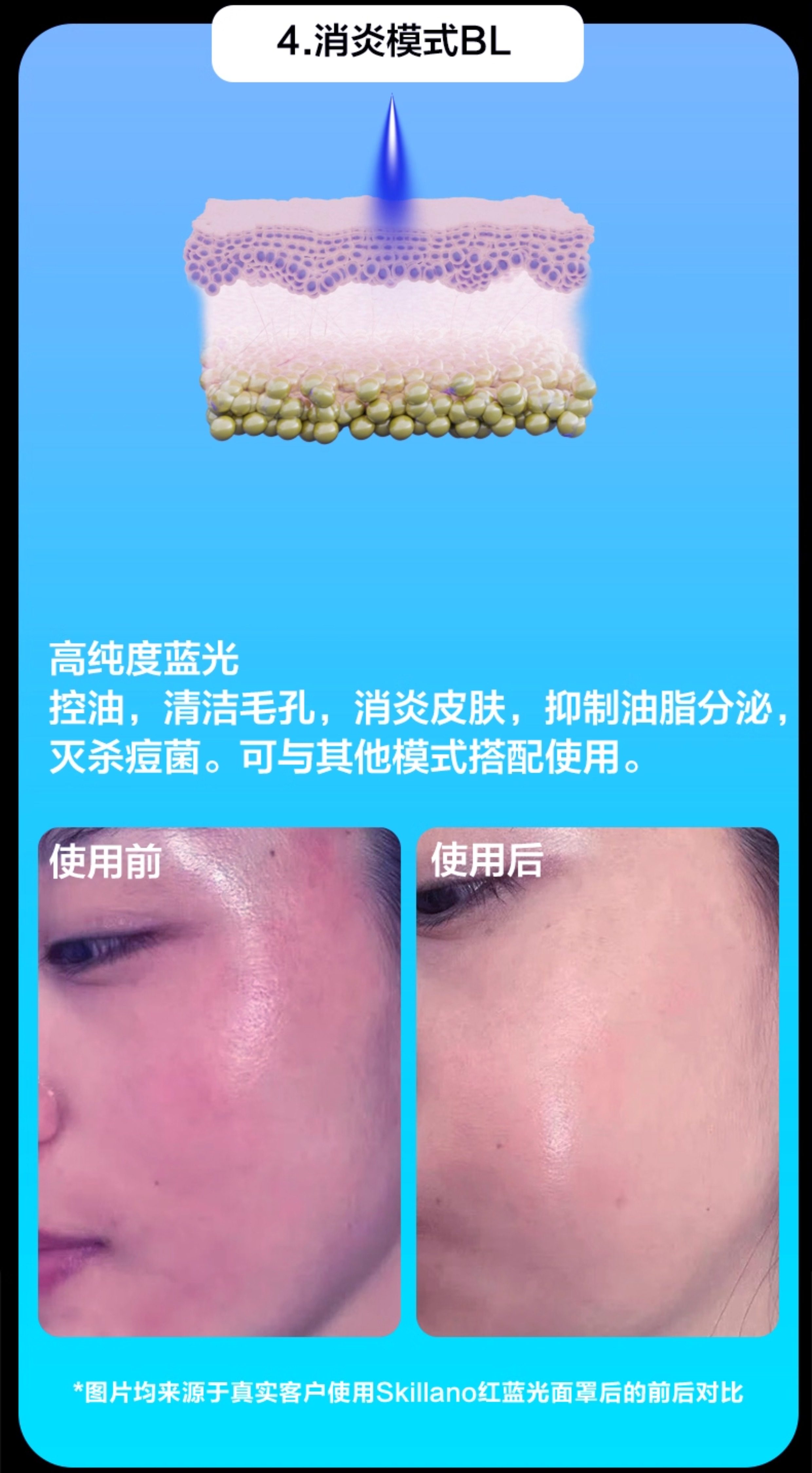 Инструмент LED красоты skillano丝柯兰诺光子嫩肤红蓝光美容脸部祛痘面罩光谱仪led仪器