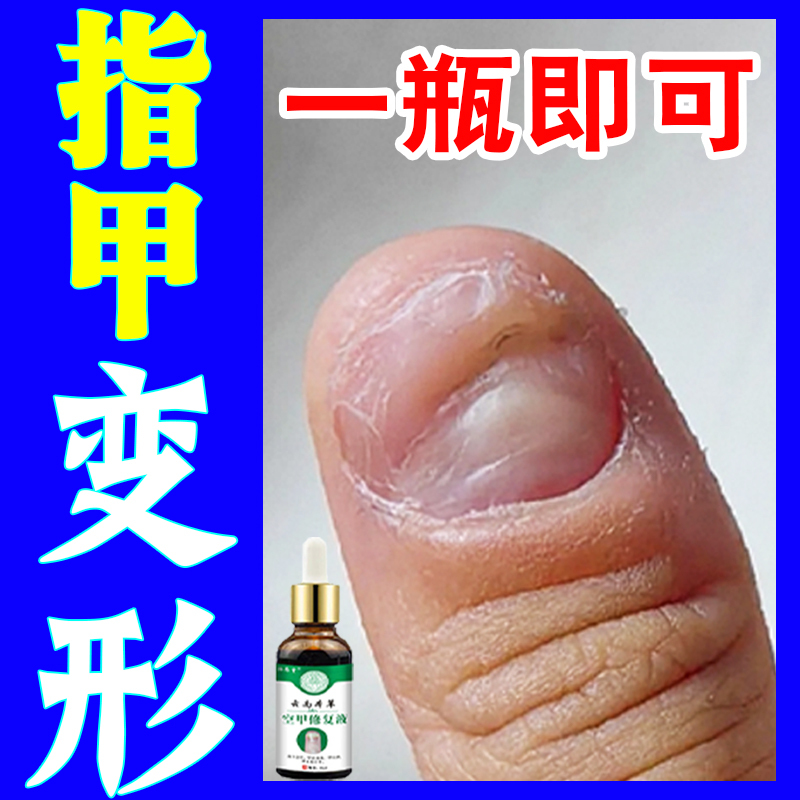Nail Deformation Correction and Repair Solution to Remove Thickened, Uneven Nails, Separate Nail Flesh, and Address Nail Biting