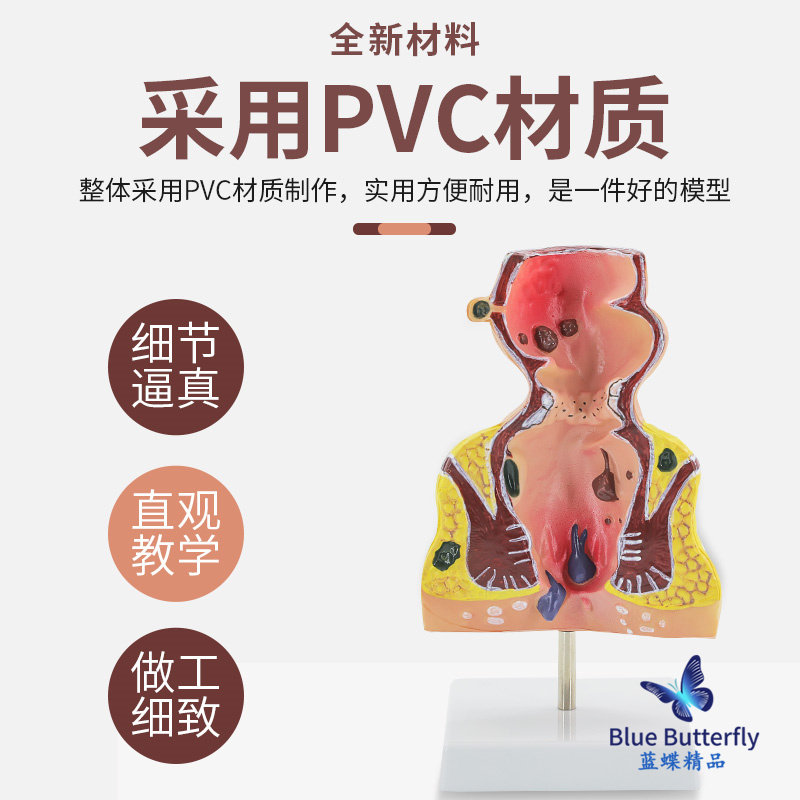 Straight Intestines Hemorrhoids Disease Turns into Model Hemorrhoids Internal and External Anatomy Anal and Intestinal Surgery Large Intestine Intestinal Pathology Model