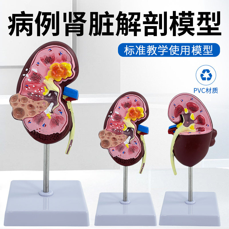 人体肾解剖模型 病理肾脏模型 正常肾部模型专业内脏器官医学教具