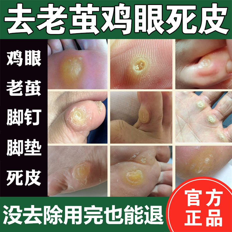 Callus and Foot Callus Remover Softener, Special Corn Cream for Hard Dead Skin and Calluses on Little Toes, Foot Sole and Pad Softening Cream