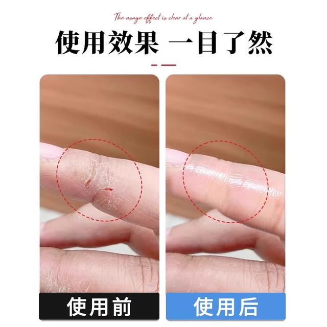 Anti-Crack Finger Patches, Anti-Allergy, Injury Protection Finger Covers, Transparent Anti-Wear Self-Adhesive Finger Covers, Anti-Cracking, Anti-Scratch