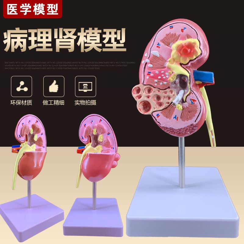 人体肾解剖模型病变肾脏模型肾脏模型人体内脏器官医学解剖模型