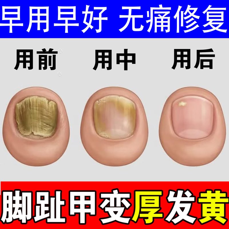 Toenails Become Thick and Yellow, the Nail Flesh Separates, the Nail Surface Is Damaged, the Nails Turn Black, Black Lines Appear on the Nails, Universal Solution for Hands and Feet Nails Toenails Become Thick and Yellow, the Nail Flesh Separates, the Nail Surface Is Damaged, the Nails Turn Black, Black Lines Appear on the Nails, Universal Solution for Hands and Feet Nails
