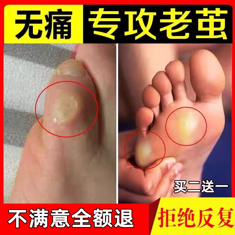 Callus removal artifact small toe hand hands callus joint callus to go sole horny dead skin special softener