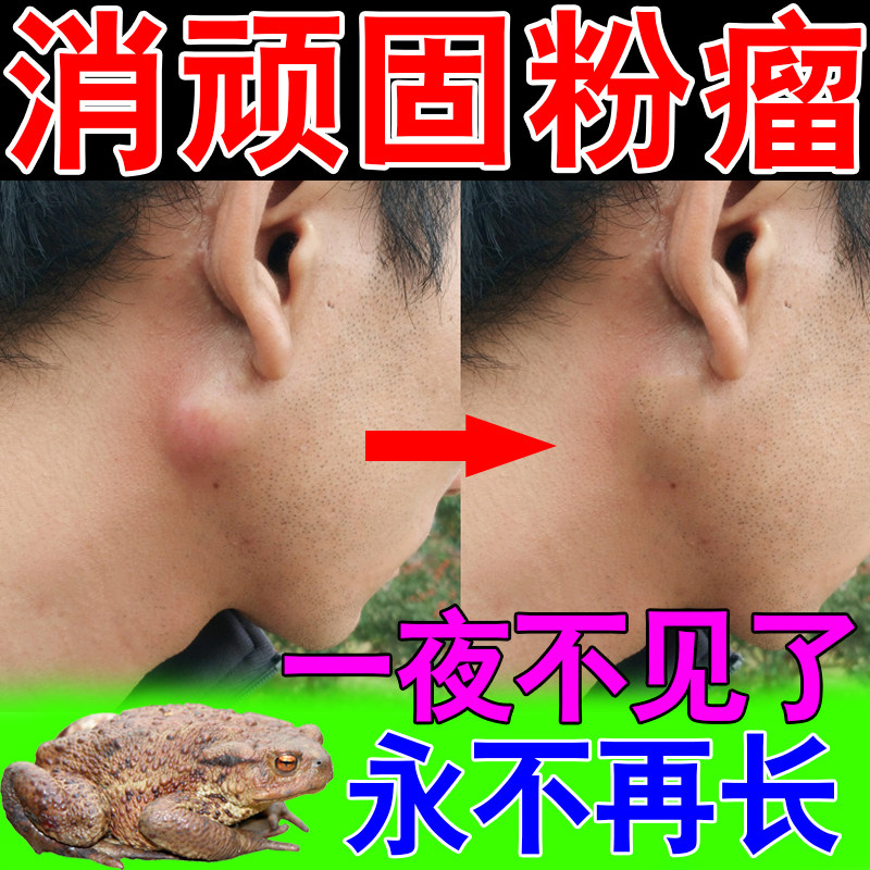 (Special for treating adenoma) sebaceous cyst blockage, dredging subcutaneous fat nodules and lumps, eliminating adenoma plaster