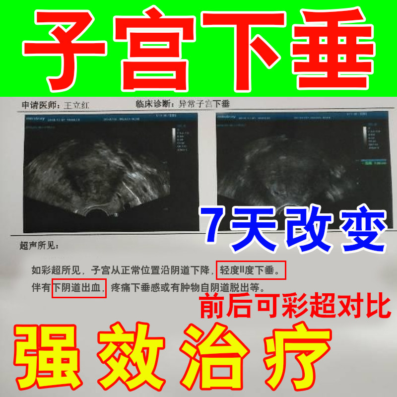Uterus--sagging lifting sticking middle-aged and elderly postpartum vaginal wall bulging prolapse trainer to restore urine leakage medicine