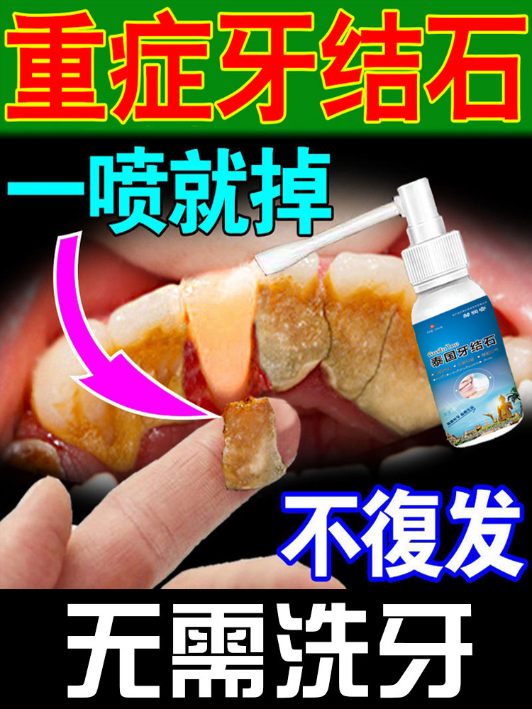 Dental calculus dissolving calculus quick-acting remover mouthwash sterilization deodorization to yellow wash white smoke stains black scale artifact