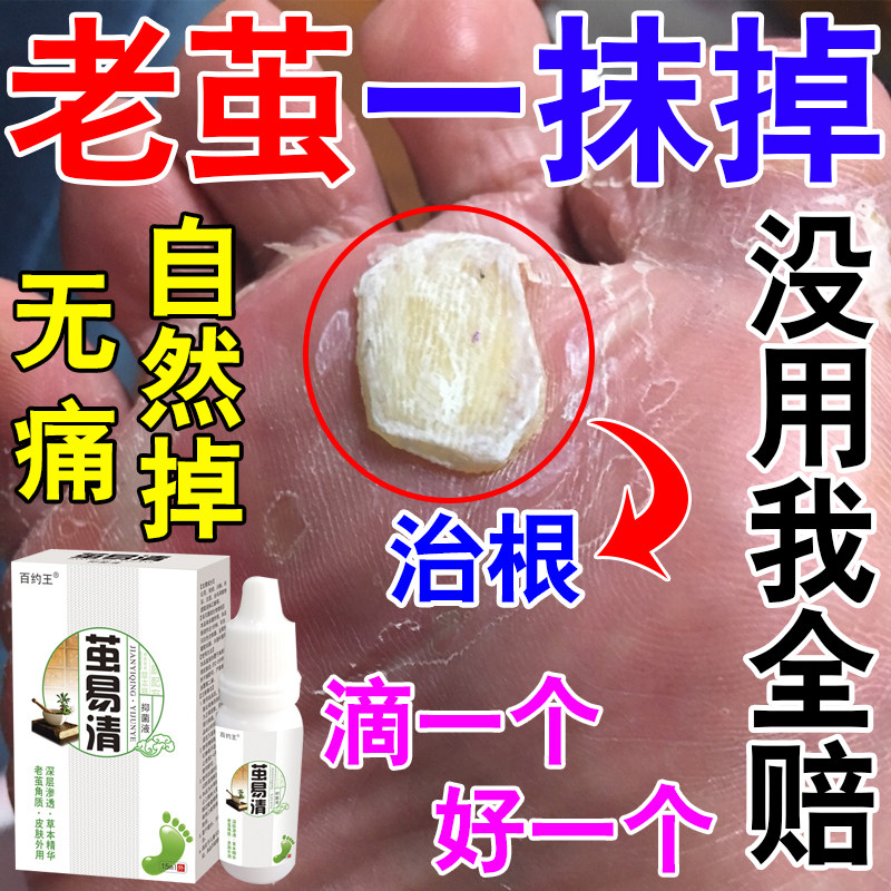 Remove the cocoon of the dead skin wart paste root chicken eye foot cocoon softener of the flesh hedgehog artifact