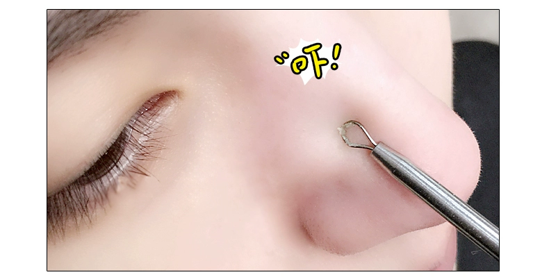 Doraduchan tre than làm trắng phim đông lạnh để trị mụn đầu đen Mụn trứng cá kiểm soát sạch mặt nạ lỗ chân lông bà bầu có sẵn - Mặt nạ