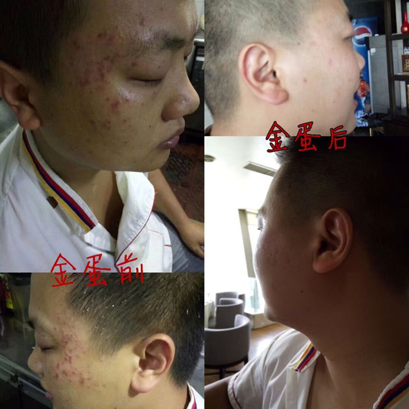 Bí quyết y học Trung Quốc Newwey với kem trị mụn trứng vàng nhỏ giúp làm sáng da mụn trứng cá kem trị mụn trứng cá nam nữ kem dưỡng da cho da dầu mụn