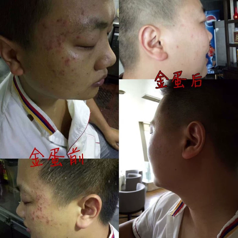 Bí quyết y học Trung Quốc Newwey với kem trị mụn trứng vàng nhỏ giúp làm sáng da mụn trứng cá kem trị mụn trứng cá nam nữ kem dưỡng ý dĩ
