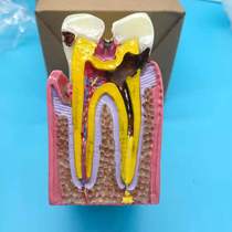 Dental Dental Model Caries Communicate Explain Front Accessories Accessories Decoration Dental Oral Material