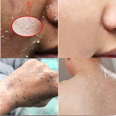 Men's face, arm pores blocked, leg body, men's deep layer, clean exfoliation, dehulling, black head gel