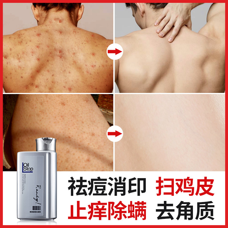 Men's bath salt whole body to remove back chest acne removal mites sterilization back acne print scrub acne-removing shower gel