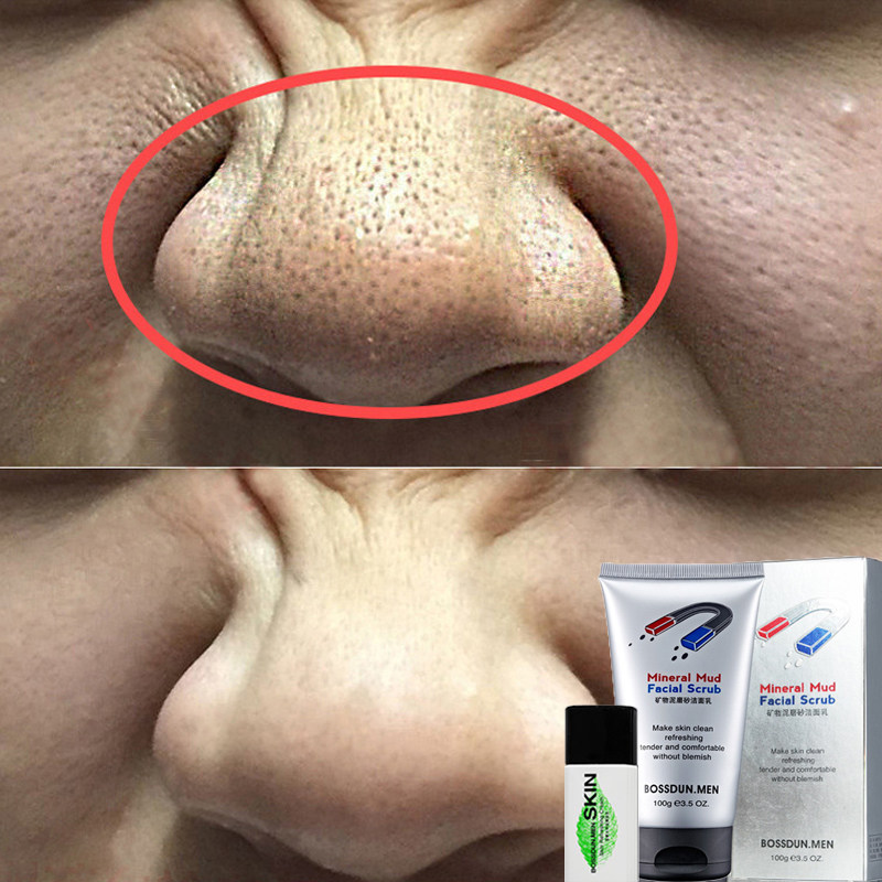 Male frosted grain to black head pimple acne scar shrink pores coarse large control oil men's wash face milk suit combined clothing