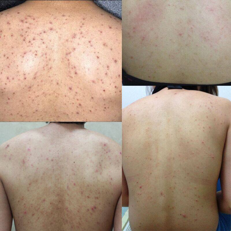 Bath salt remove back pox from back pox to back pox in back to back pox in the back of the pox
