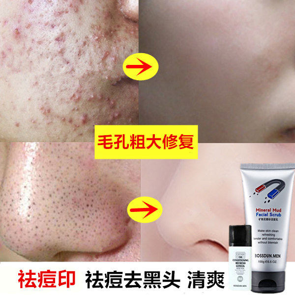 Acne Printing Pimple Scars Painting Men Wash Face Boys Wash Milk Oil Control Oil Acne Clean to Black Head