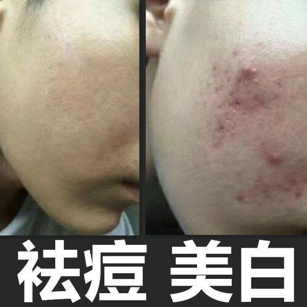 Facial cleanser for men's special oil control, acne, hydrating, whitening, whitening, acne marks, blackheads, student cleansing