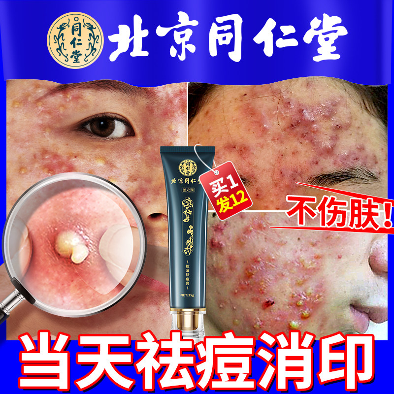 Beijing Tongrentang acne-removing acne-printing and acne-pit repair cream lightening and anti-inflammatory acne-removing acne scars
