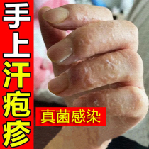Ringworm fungal infection sweat herpes ointment peeling blisters itchy blisters small blisters tinea pedis psoriasis
