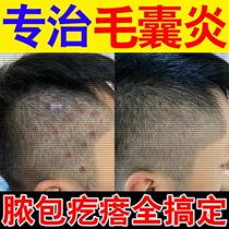 Head with lumpy dandruff severe to miticide scalp follicular hair follicle shampoo special drug head seatopic dermatitis
