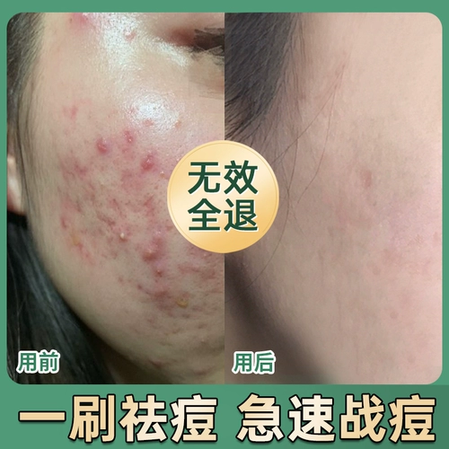 Ватные диски с салициловой кислотой от черных точек подходит для мужчин и женщин, анти-акне, скрывает прыщи, сужает поры