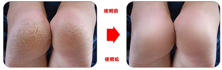 Vớ chân giữ ẩm Gel làm trắng chân chống nứt chân Chân chống trượt vớ điều hòa nhiệt độ
