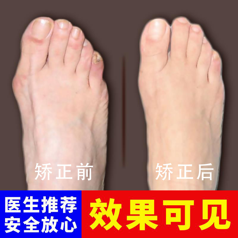 True thumb valgus braces Say goodbye to big toe bending Day and night with healthy orthosis to remove big toe valgus