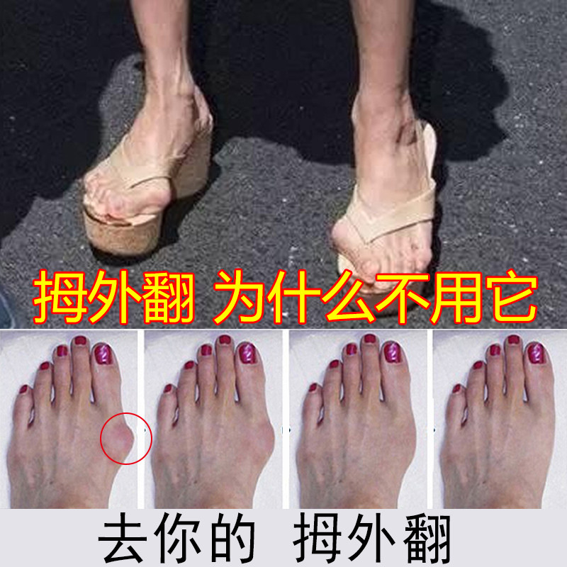 Reflexive correction of big toe bone Thumb valgus correction device makes your thumb bone healthy as new and no longer deformed